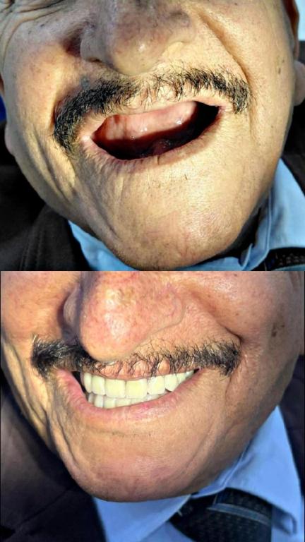 كلية طب الأسنان – جامعة أهل البيت عليهم السلام: طالبة تحقق تعويضا ناجحا لأسنان مفقودة في عيادة الصناعة